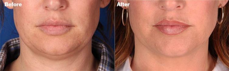 Chin Liposuction Before and After