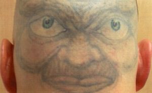 Tattoo Removal, Tattoo Off– Palm Springs, Palm Desert 