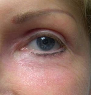IPL Laser Photo Gallery Before and After, Palm Desert 