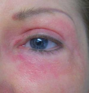 IPL Laser Photo Gallery Before and After, Palm Desert 