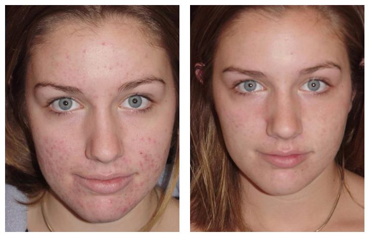 face scars from acne