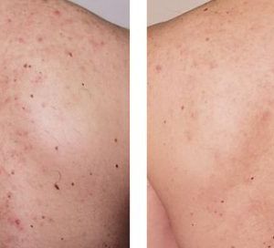 Back Acne Scars Treatment, Before & After