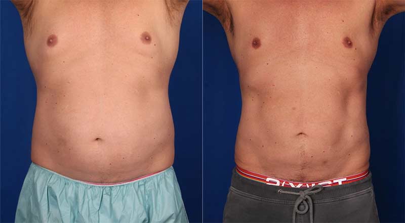 CoolSculpting - Upper & Lower Flanks Before & After Gallery - Case 4437