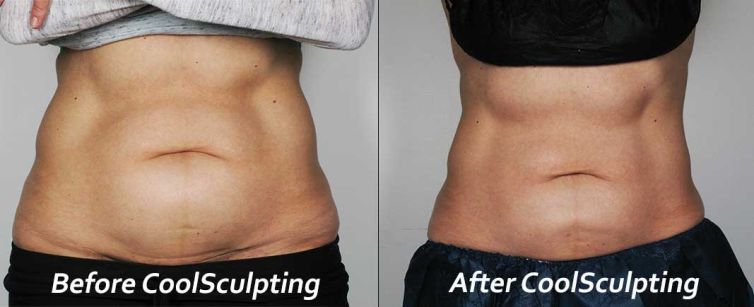 CoolSculpting Before & After
