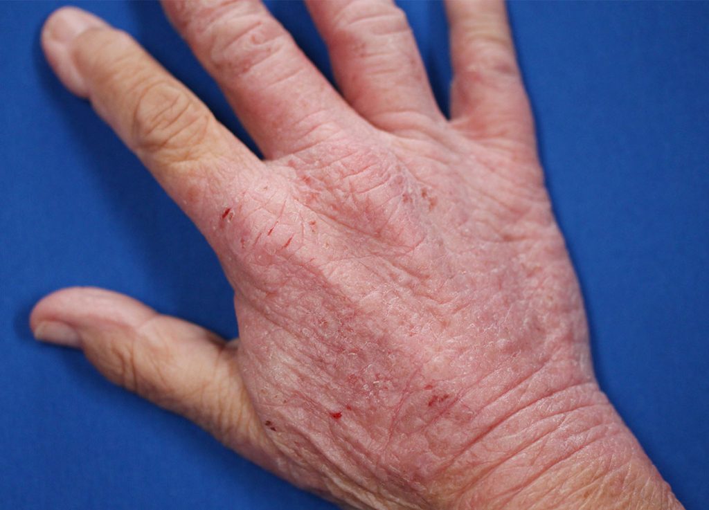 Eczema On Hands In Winter