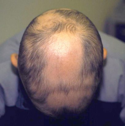 Alopecia Areata Treatment | Contour Dermatology