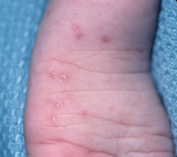 Scabies Treatment | Palm Desert |Palm Springs | Contour Dermatology