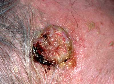 Squamous Cell Carcinoma Treatment