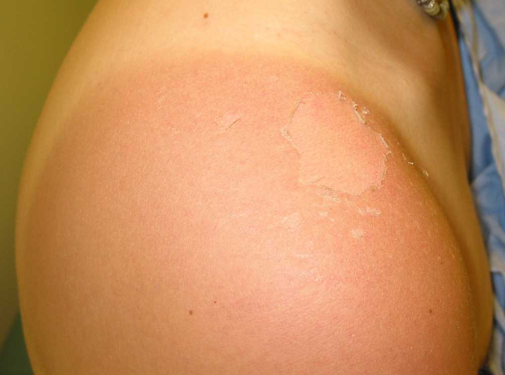 Sunburn Treatment | Palm Desert | Palm Springs | Contour 