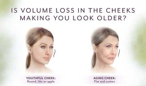 Is Volume loss in the cheeks making you look older/ Try Voluma