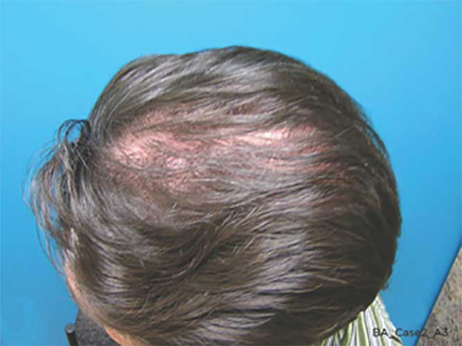 Capillus The Easiest Way To Treat Thinning Hair Palm Desert Palm Springs Contour Dermatology 9646