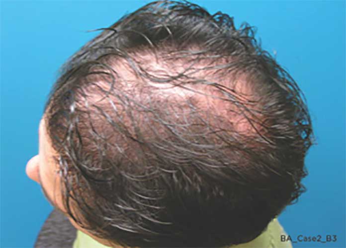 Capillus The Easiest Way To Treat Thinning Hair Palm Desert Palm