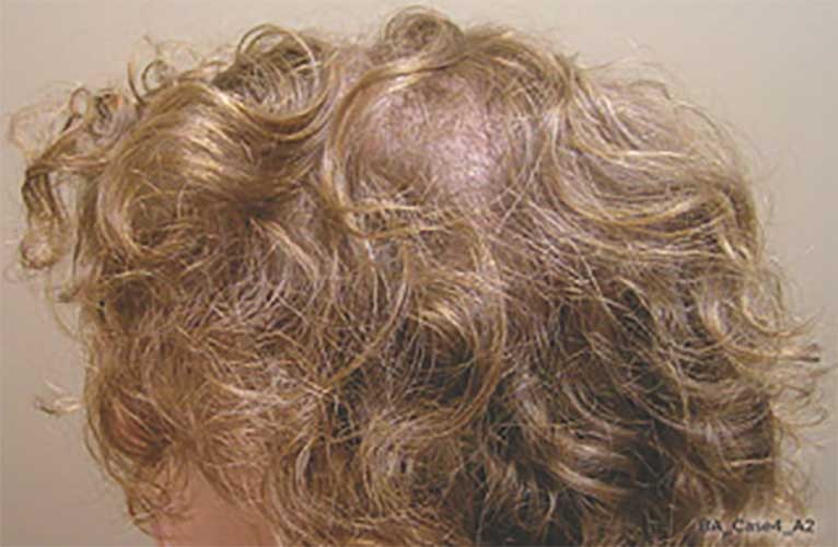 Capillus The Easiest Way To Treat Thinning Hair Palm Desert Palm 