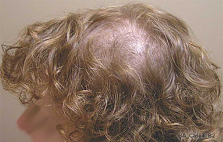 Capillus The Easiest Way To Treat Thinning Hair Palm Desert Palm
