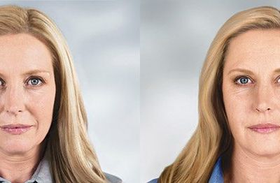 Sculptra before and after