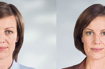 Sculptra before and after