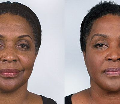 Sculptra before and after