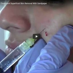 11-03-2014 Acne Scar Treatment Dermabrasion | Contour Dermatology