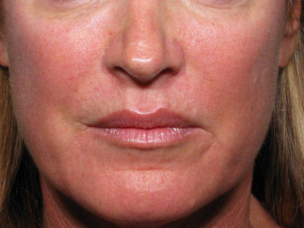 Contour Dermatology Restylane After