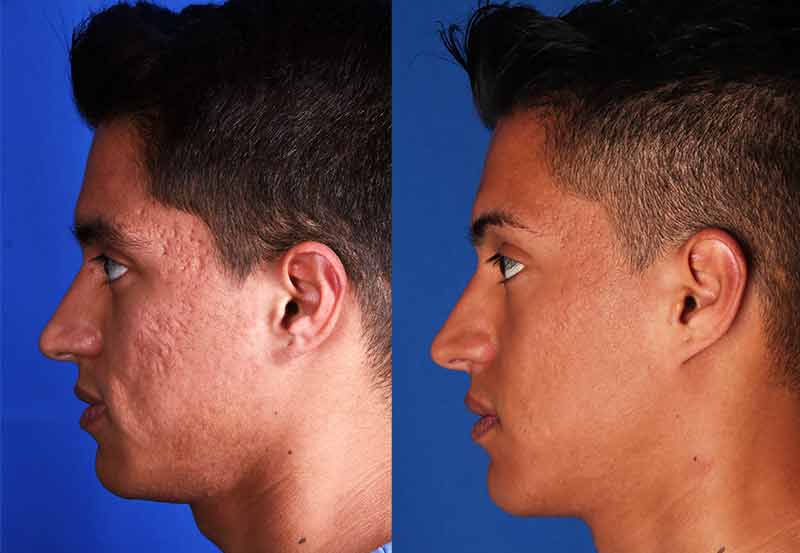 Acne Scars Treatment Before and After Photos