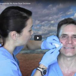 Elaine and Dr Jochen Demonstrate An Acne Scar Excision