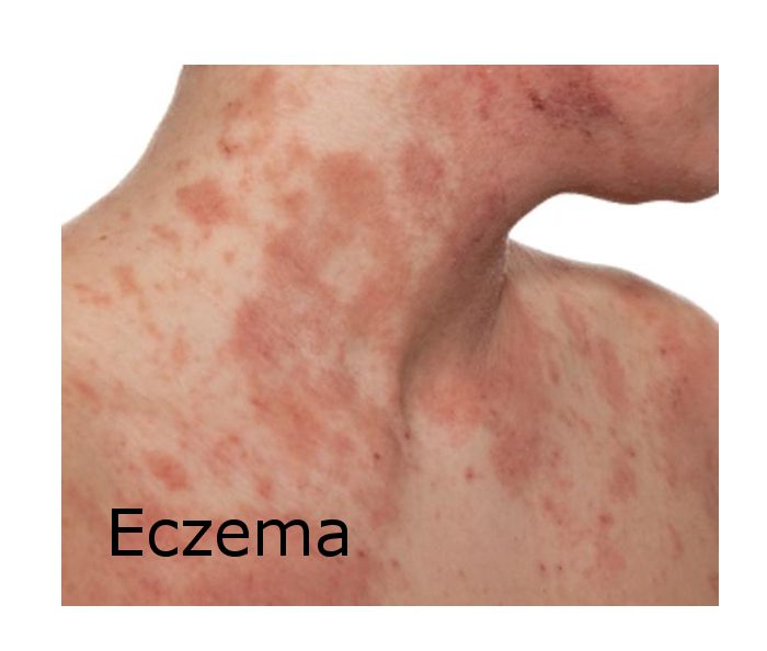 Contour Dermatology – eczema-web