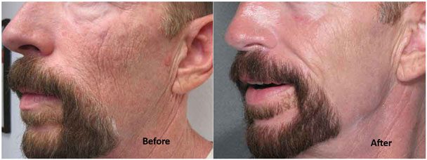 Laser wrinkle reduction for men at Contour Dermatology