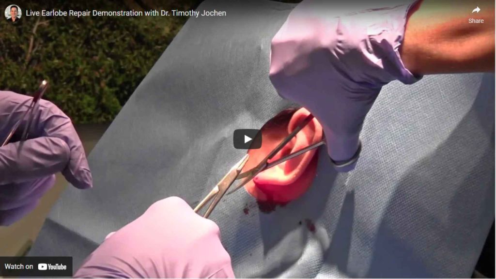 Are your earlobes hanging down from heavy earrings or other deformities? Dr. Jochen show how to fix earlobes with this simple surgery. The result is beautiful earlobes!
