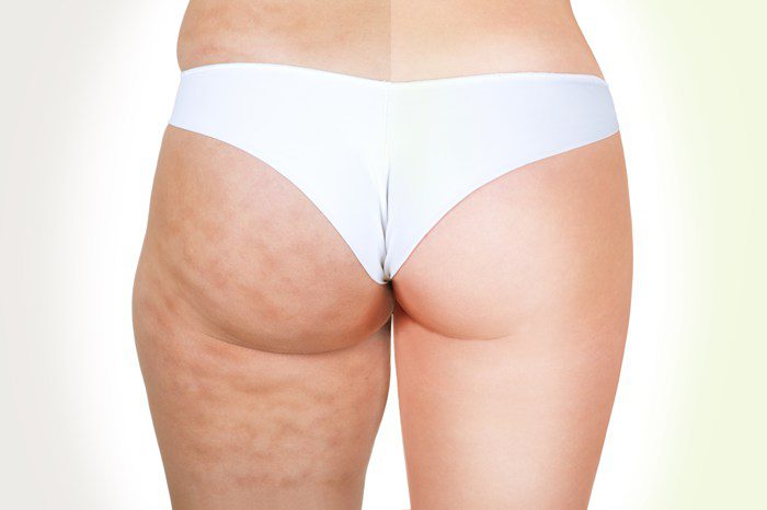 Cellulite, Before & After Treatment
