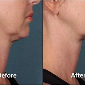 Kybella, Before and After, Actual Patient, Side View