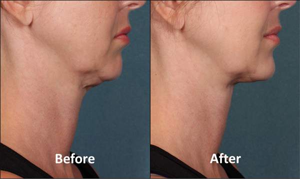 Kybella, Before and After, Actual Patient, Side View