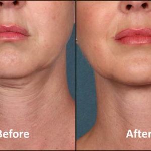 Kybella, Before and After, Actual Patient