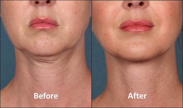 Kybella, Before and After, Actual Patient