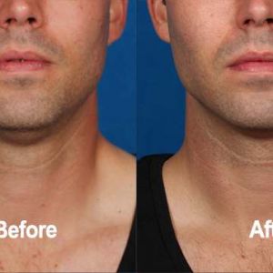 Kybella, Before and After, Actual Patient, Front View, Male