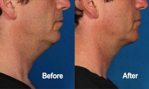 Kybella - Treatment to Reduce Double Chins | Contour Dermatology