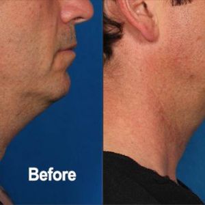 Kybella, Before and After, Actual Patient, Side View, Male