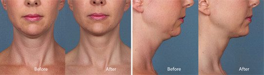 Kybella Before and After Photos at Contour Dermatology