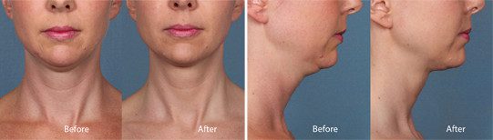 Kybella Before + After Photos - Purely Aesthetics