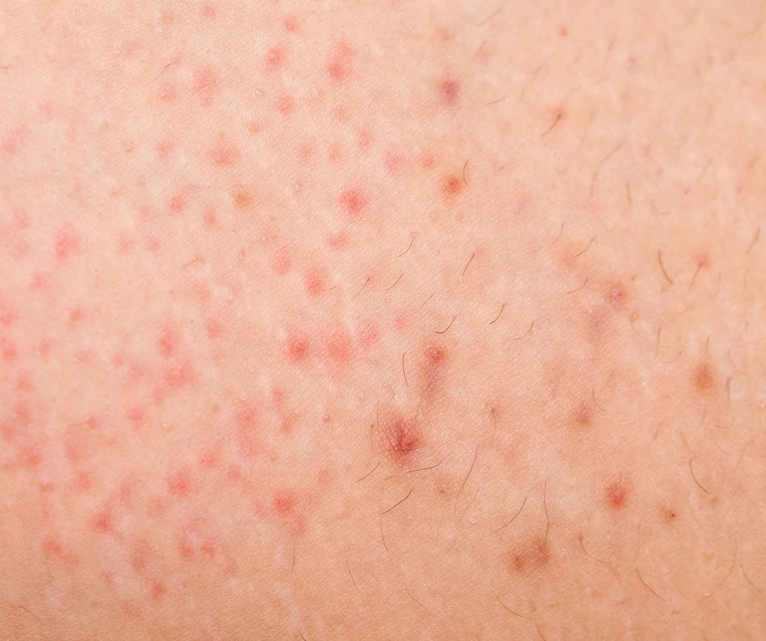 Folliculitis can be difficult to distinguish from acne, especially on the face. Consult your dermatologist if you think you have folliculitis to discuss what treatment options are best for you.