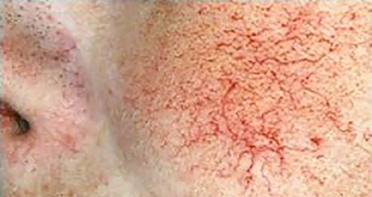 Rosto Com Telangiectasia Telangiectasia Of The Facial Skin And Lips In Rosto Com Telangiectasia Telangiectasia Of The Facial Skin And Lips In
