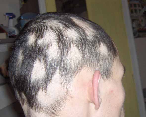 clobetasol propionate for hair loss