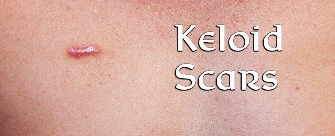 Keloid Scars | Contour Dermatology