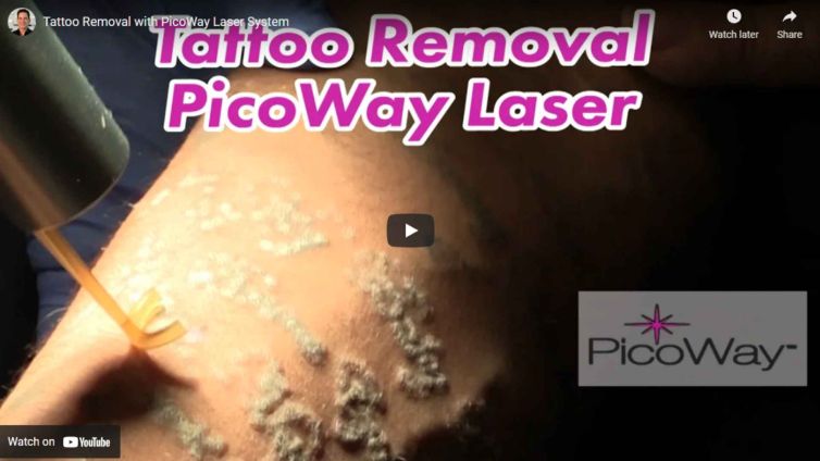 Tattoo Removal with The PicoWay Laser
