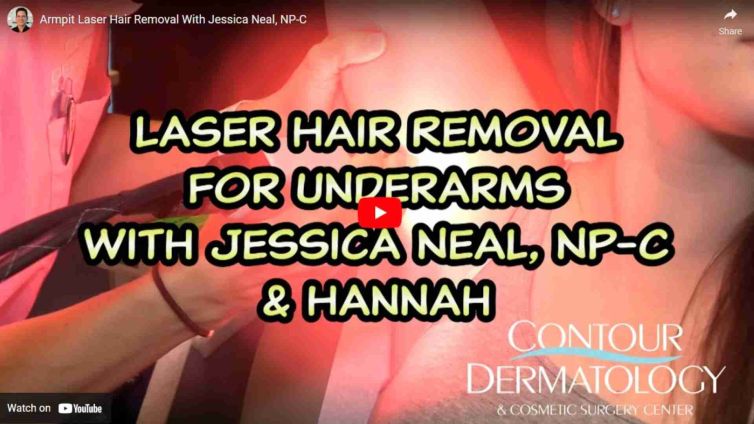 Armpit Laser Hair Removal With Jessica Neal, NP-C