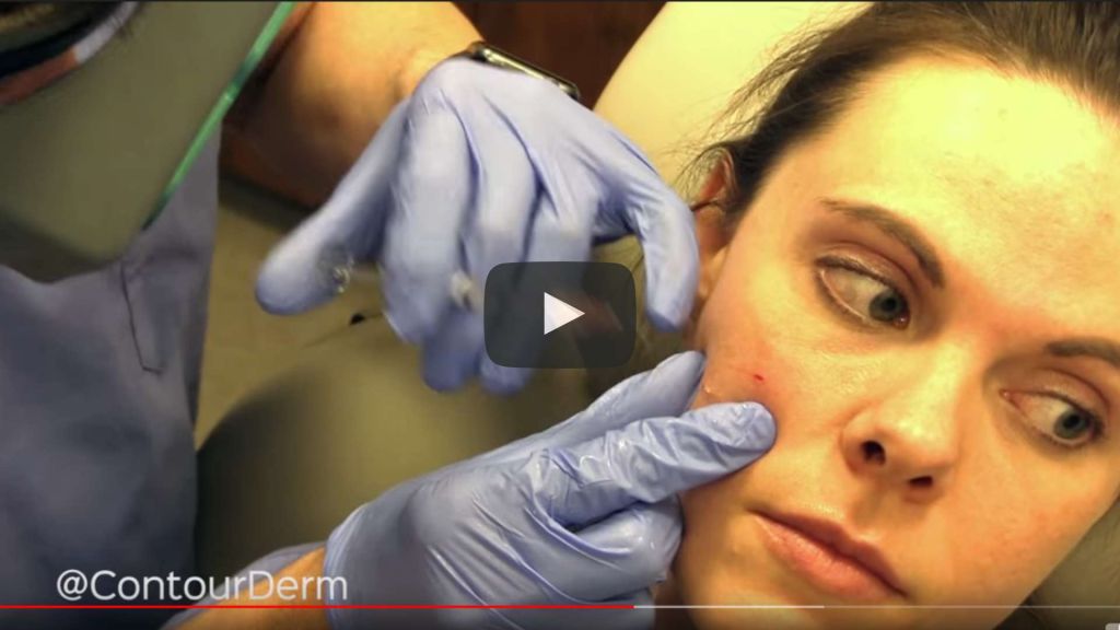 In this video, Timothy Jochen, MD, demonstrates a skin tag removal and then uses Restylane facial filler to improve the appearance of acne scarring. At the end he also demonstrates an acne scar subscission.