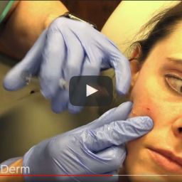 20160413-Acne-Scar-Revision | Contour Dermatology