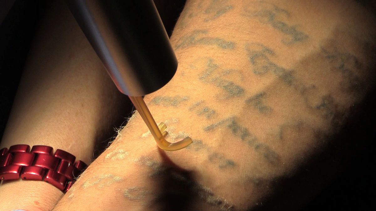 PicoWay Tattoo Removal Laser in action.
