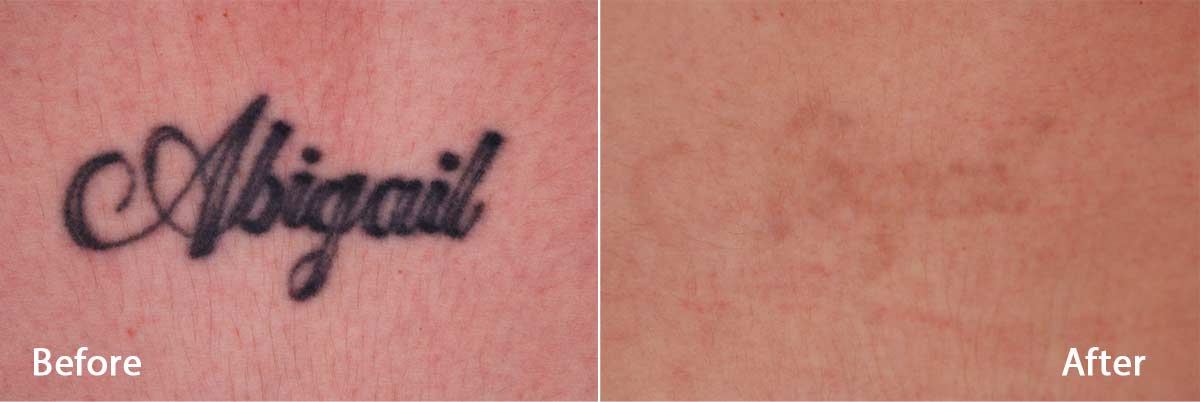 Laser Tattoo and Permanent Makeup  Friedman Dermatology