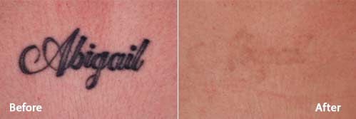 Pico Way Tattoo Removal Before and After Photo