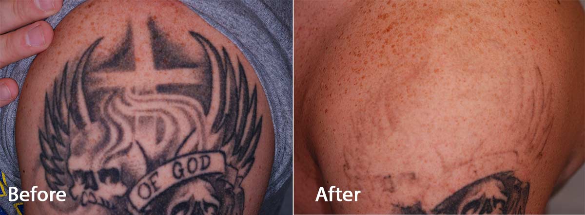 Pico Laser - PicoWay Laser - Tattoo Removal | Contour Dermatology